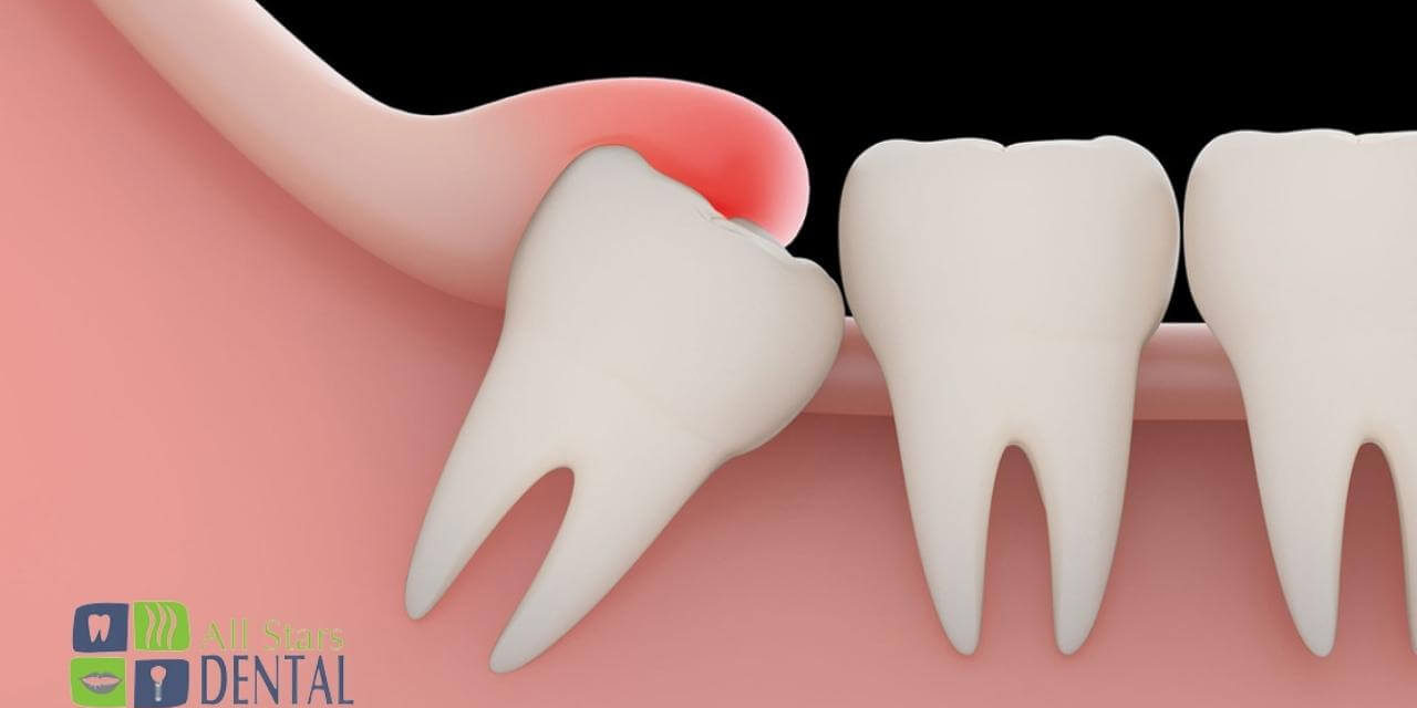 How Long Does Numbness Last After Wisdom Teeth Removal?