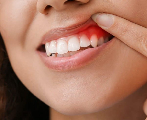 dental clinic Houston| gum disease treatments