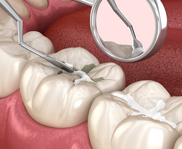 dental sealants Houston | dental sealants procedure