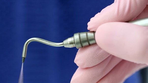 air abrasion Houston