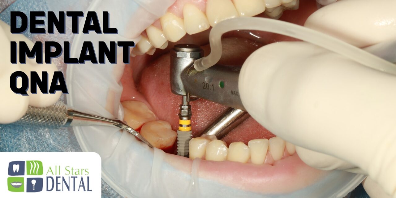 Some Common Dental Implant Questions Answered That You Have To Know
