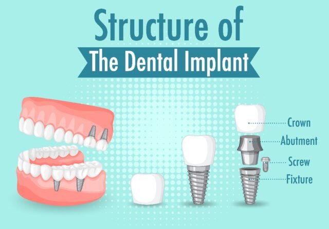 dental implants in Houston