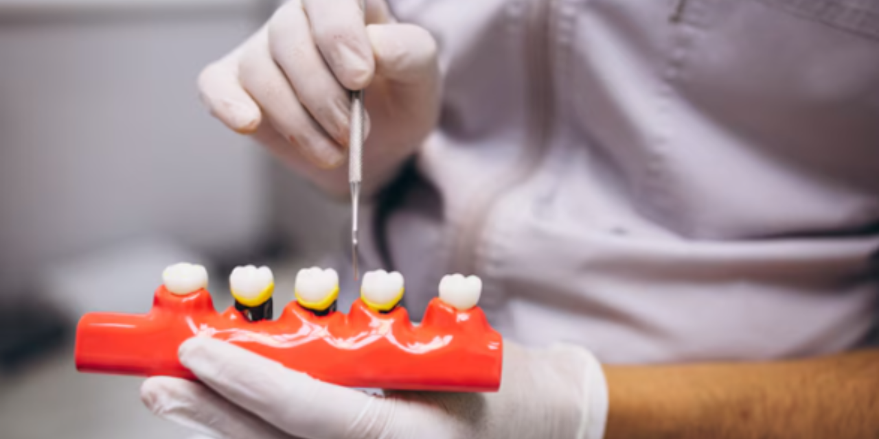 How Long Do Dental Crowns Last? A Comprehensive Guide