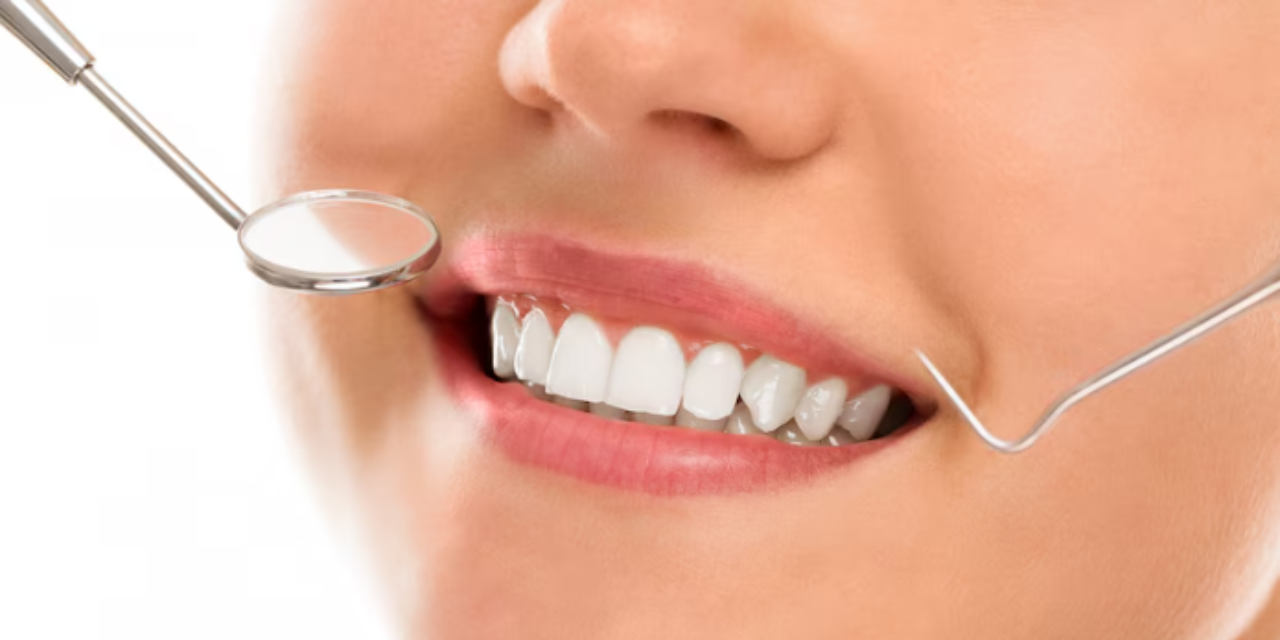 Should You Think About Teeth Whitening in Houston?