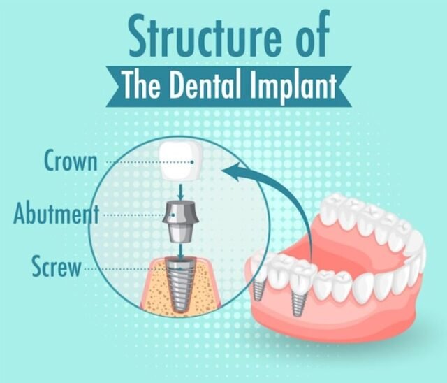 dental implant restoration in Houston TX 