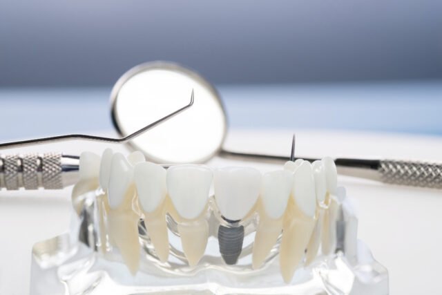 https://allstarsdental.com/wp-content/uploads/2025/02/Dental-Implant-1-640x427.jpg