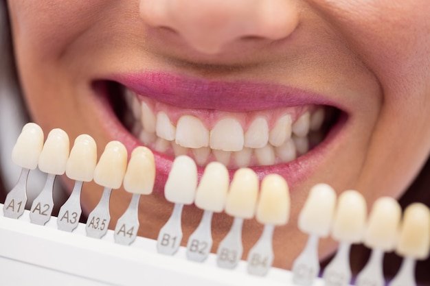 https://allstarsdental.com/wp-content/uploads/2025/02/Teeth-Whitening-2.jpg