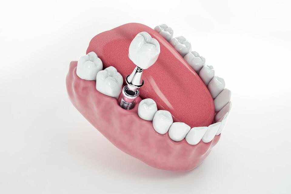 dental reconstruction in Houston