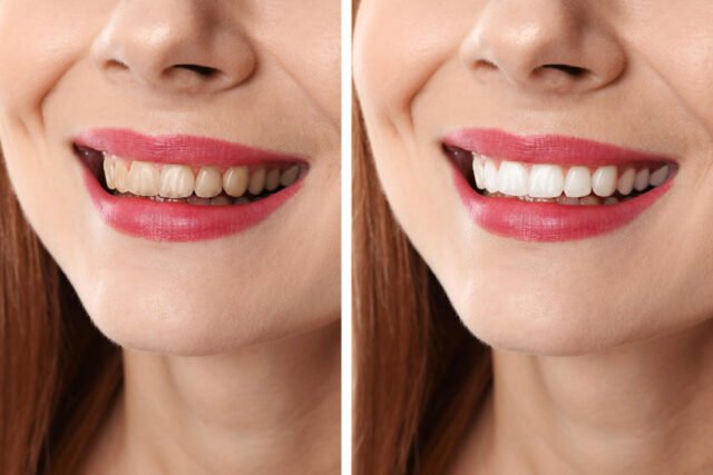 Collage with photos of woman before and after teeth whitening closeup