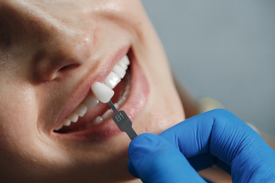 How Long Does Dental Reconstruction Take in Houston? A Step-by-Step Breakdown