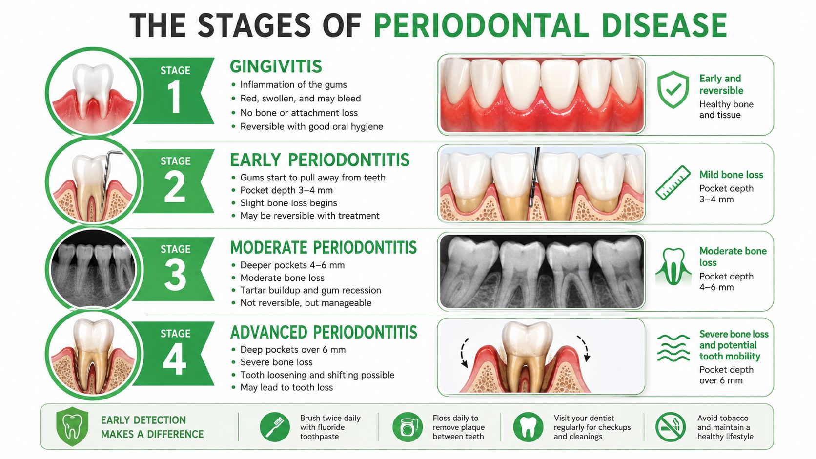 A dental infographic detailing the four stages of periodontal disease, from gingivitis to advanced periodontitis progression.