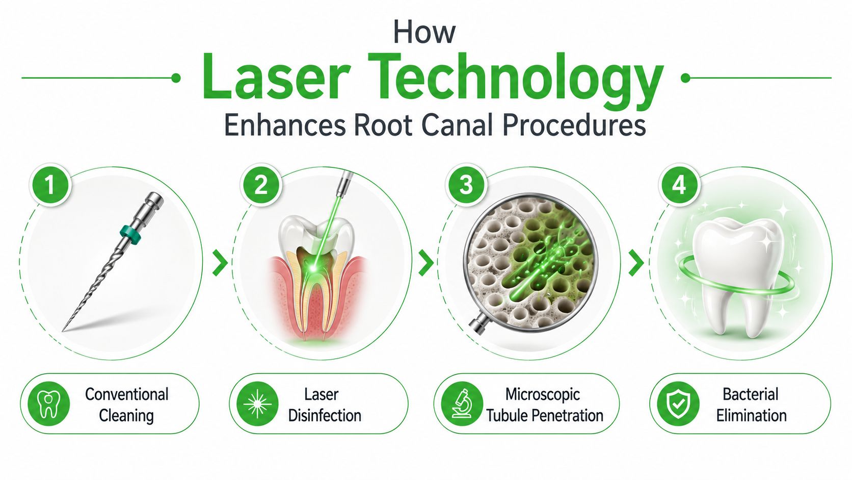 An infographic showing the four-step process of how laser technology enhances dental root canal procedures.